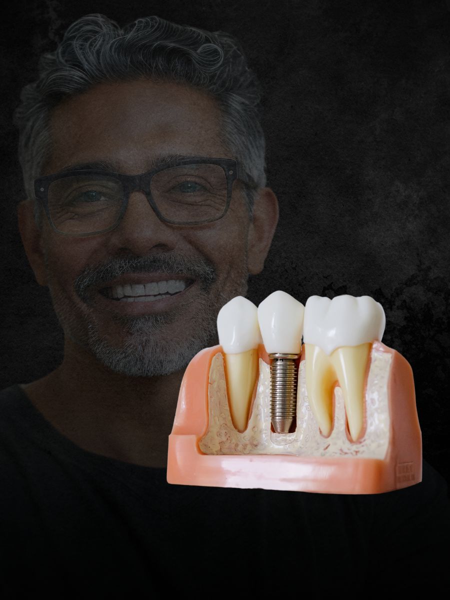 Dental-Implants