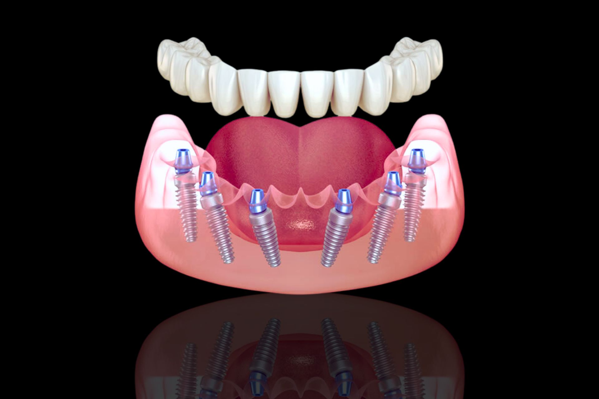 All-on-4/6 Implants In Faridabad