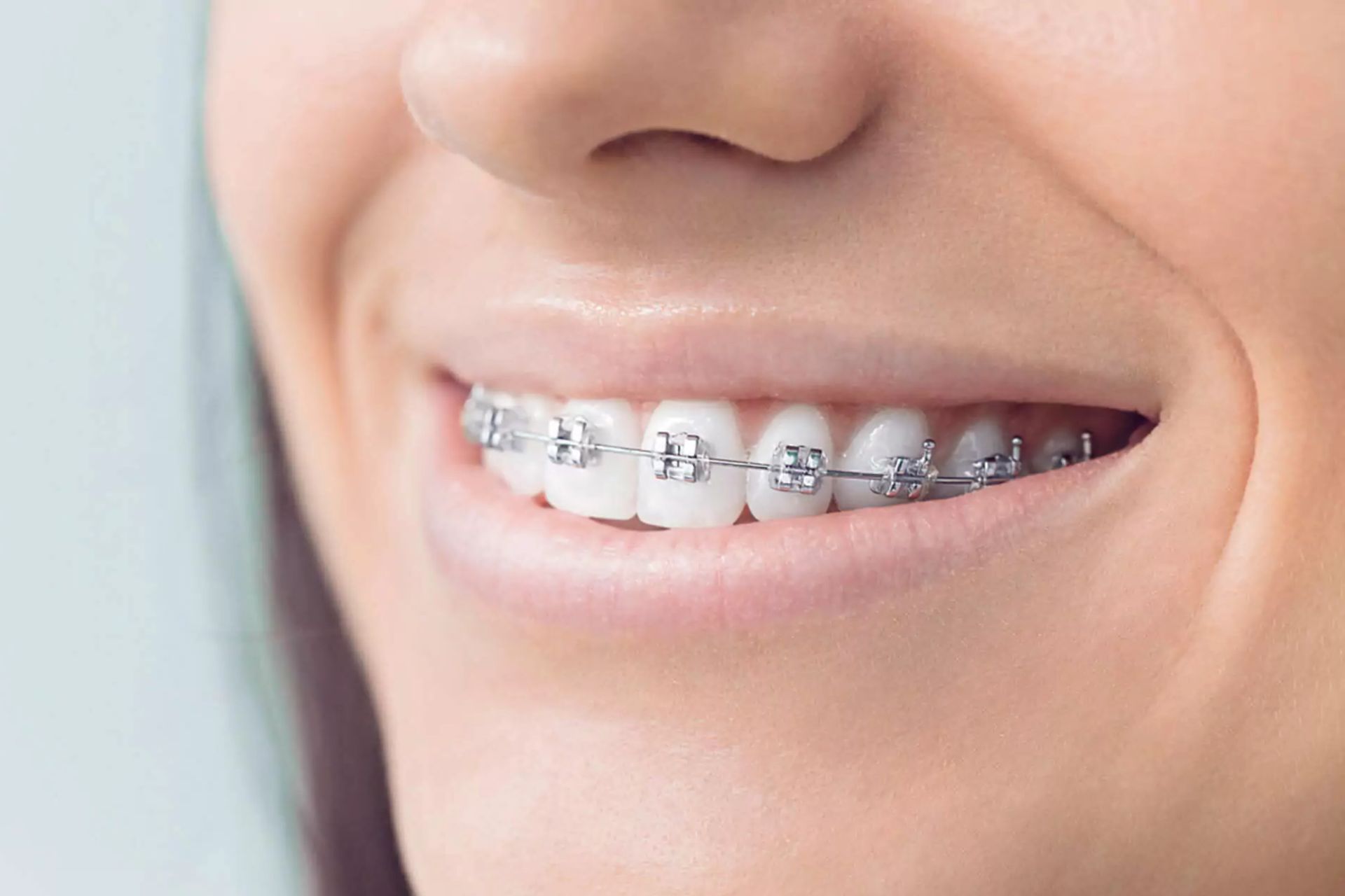 Braces Treatment In Faridabad