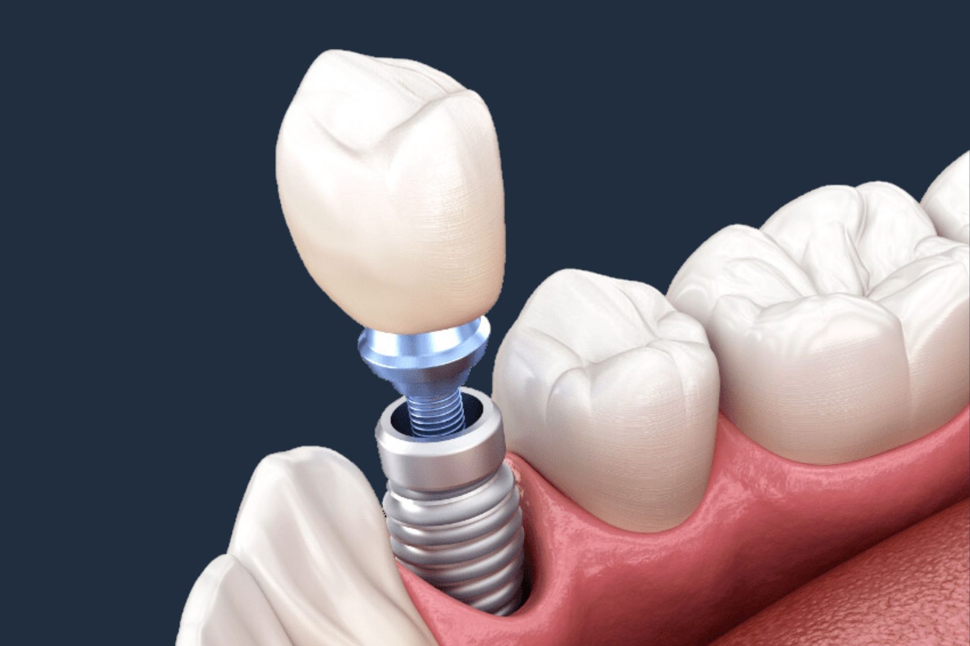 Dental Implants In Faridabad