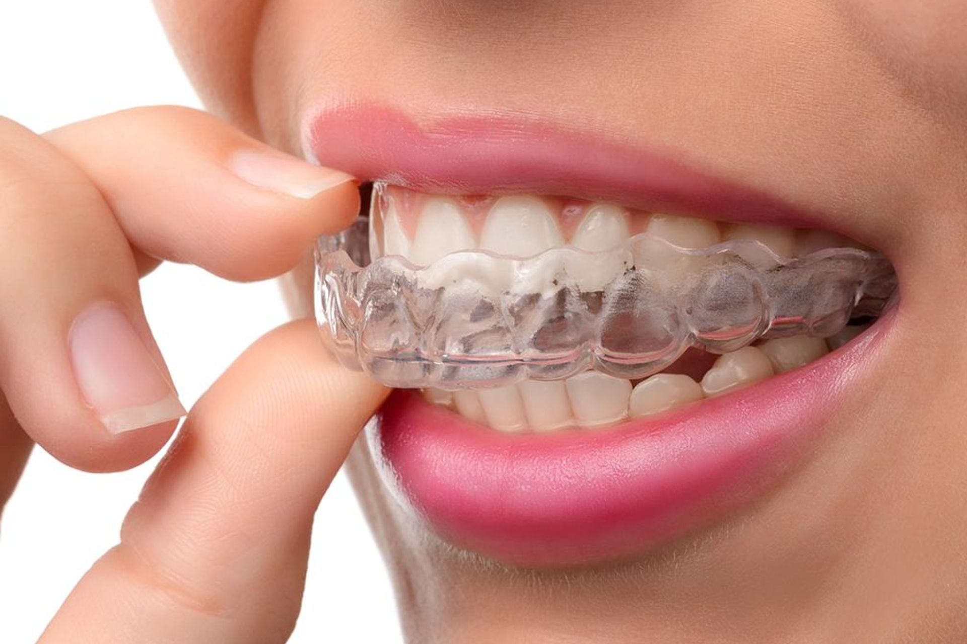 Invisalign In Faridabad