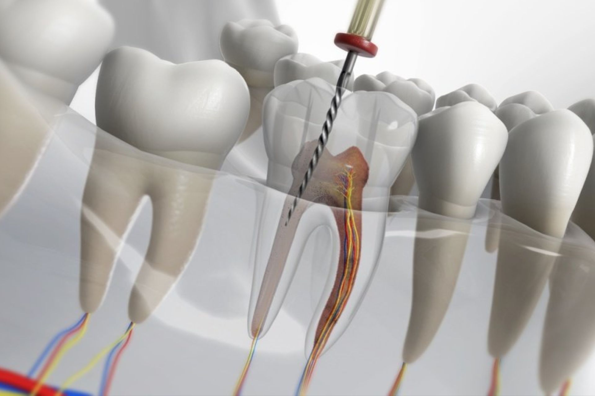 Root-Canal-Treatment In Faridabad