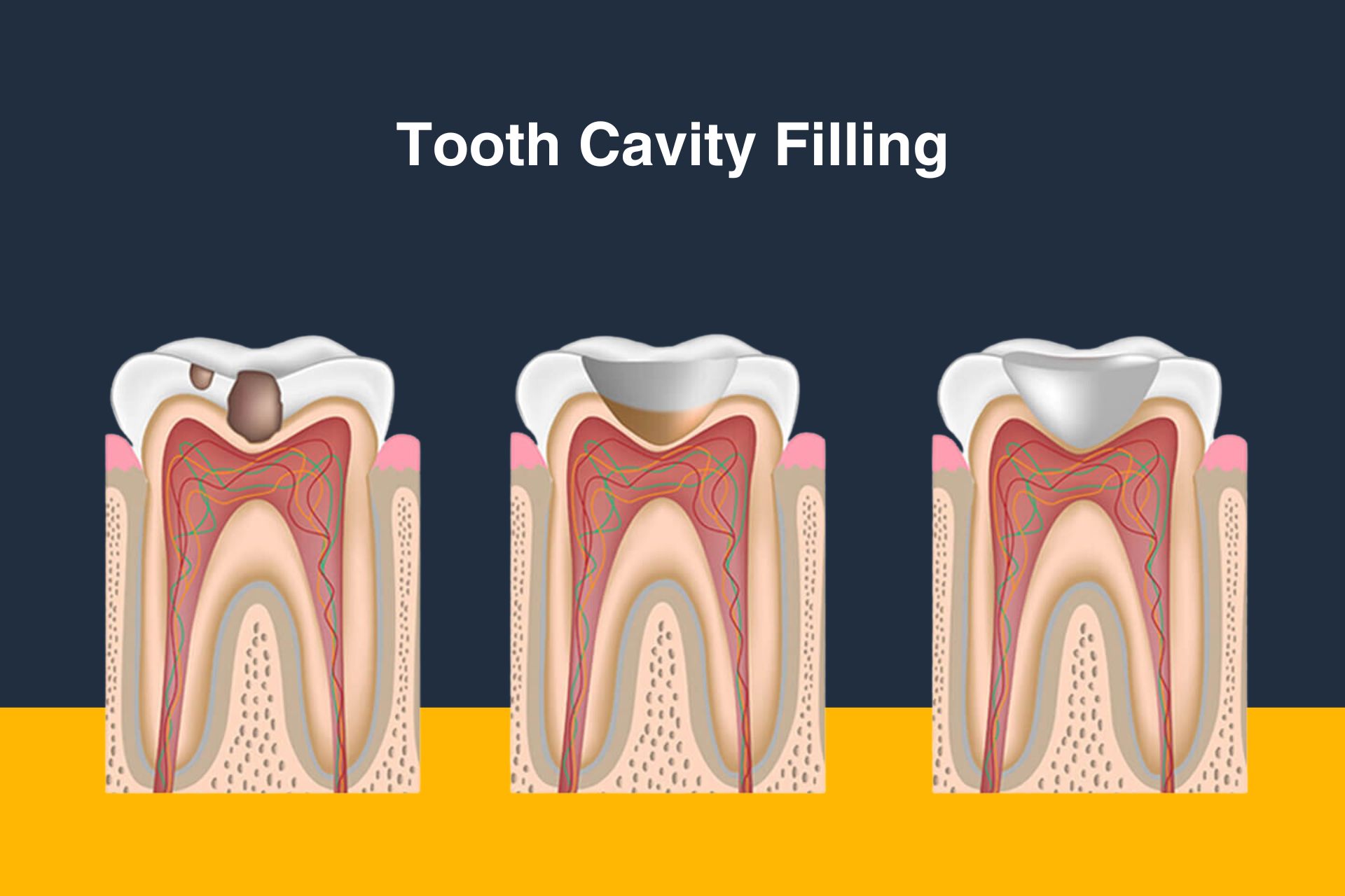 Cavity Filling In Faridabad