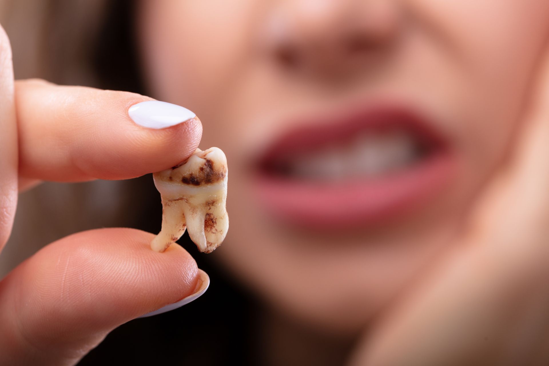 Wisdom Tooth Removal In Faridabad